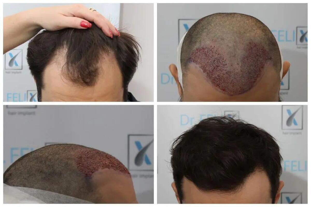 implant de par Dr Felix Hair Implant